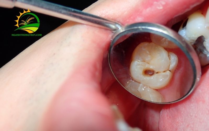 Phương pháp dân gian trị sâu răng bằng lá ổi: Hiệu quả và những lưu ý quan trọng 6 trị sâu răng bằng lá ổi